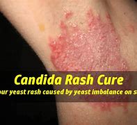 Image result for Candida Skin Rash Symptoms