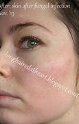 Image result for Candida Face