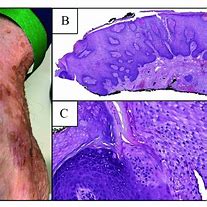 Image result for Dorsal Thenar Eminence