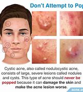 Image result for Deep Acne Cyst