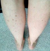 Image result for Dark Age Spots On Legs