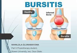 Image result for Sasd Bursitis