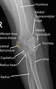 Image result for Normal Elbow Joint