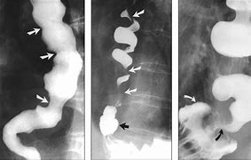 Image result for Esophageal Sphincter Spasm