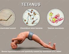 Image result for Tetanus Patient