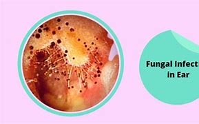 Image result for Yeast Infection in Ear Canal