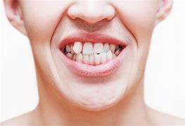 Image result for Uneven Smile Stroke