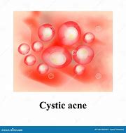 Image result for Pustules and Inflammatory Acne