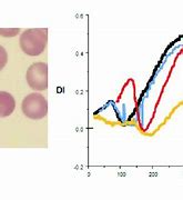 Image result for Pyropoikilocytosis