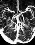 Image result for CT Angiogram Brain Anatomy