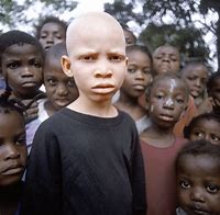 Image result for White Albino Africans