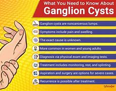 Image result for Ganglion Cyst in Capitate