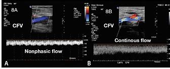 Image result for Nonphasic Venous Flow