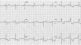 Image result for RVH ECG