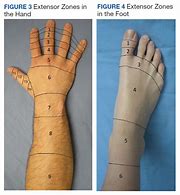 Image result for Thumb Extensor Tendonitis