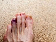 Image result for Broken Toe Bone