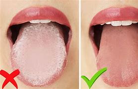 Image result for White Tongue Coating Candida