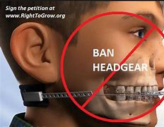 Image result for Draw Me a Picture of Orthodontic Headgear