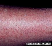 Image result for Photos of Eczema Asteatotic