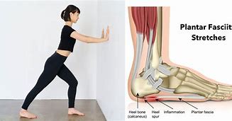 Image result for plantar fasciitis causes