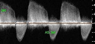 Image result for Continuous Wave Doppler Ultrasound