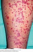 Image result for Vasculitis Signs