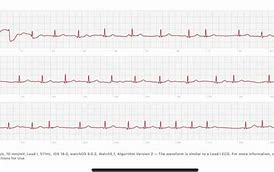 Image result for Run of SVT