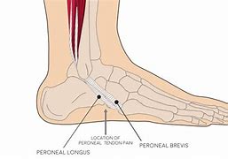 Image result for Peroneal Tendinopathy