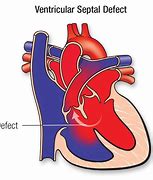 Image result for Atrial Septal Defect Blood Flow