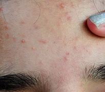 Image result for Itchy Face with Pimples