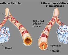 Image result for Narrowing of the Airways