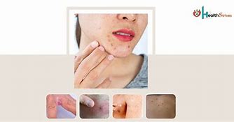 Image result for Dark Red Spots On Skin