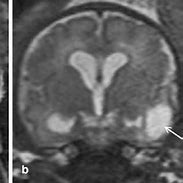 Image result for Ventricular Dilation