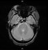 Image result for Aneurysm in MRI