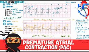 Image result for Premature Atrial Contraction