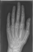 Image result for Bone Age Hand X-ray