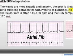 Image result for AFib vs V-fib