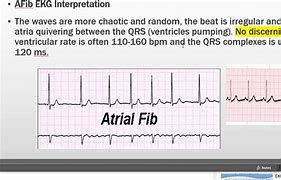 Image result for Ventricular Flutter vs Fib