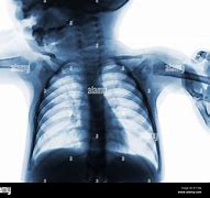 Image result for Thumb X-ray Child