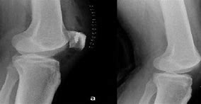 Image result for Normal Lateral Knee Radiograph