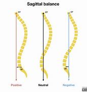 Image result for Plumb Line Scoliosis