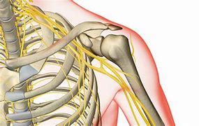 Image result for Brachial Plexus Injury