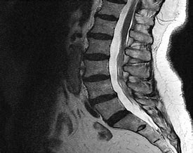 Image result for Lumbar Spine MRI 8Mm