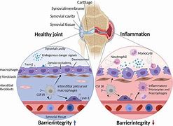 Image result for Inflammed Synovial Tissue