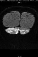 Image result for Diffusion MRI