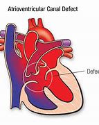 Image result for Tof with Atrioventricular Canal Defect