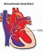 Image result for Complete Atrioventricular Canal Defect