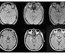 Image result for Aneurysm in MRI