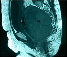 Image result for Retrocaval Cyst