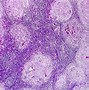 Image result for Necrosis Histology